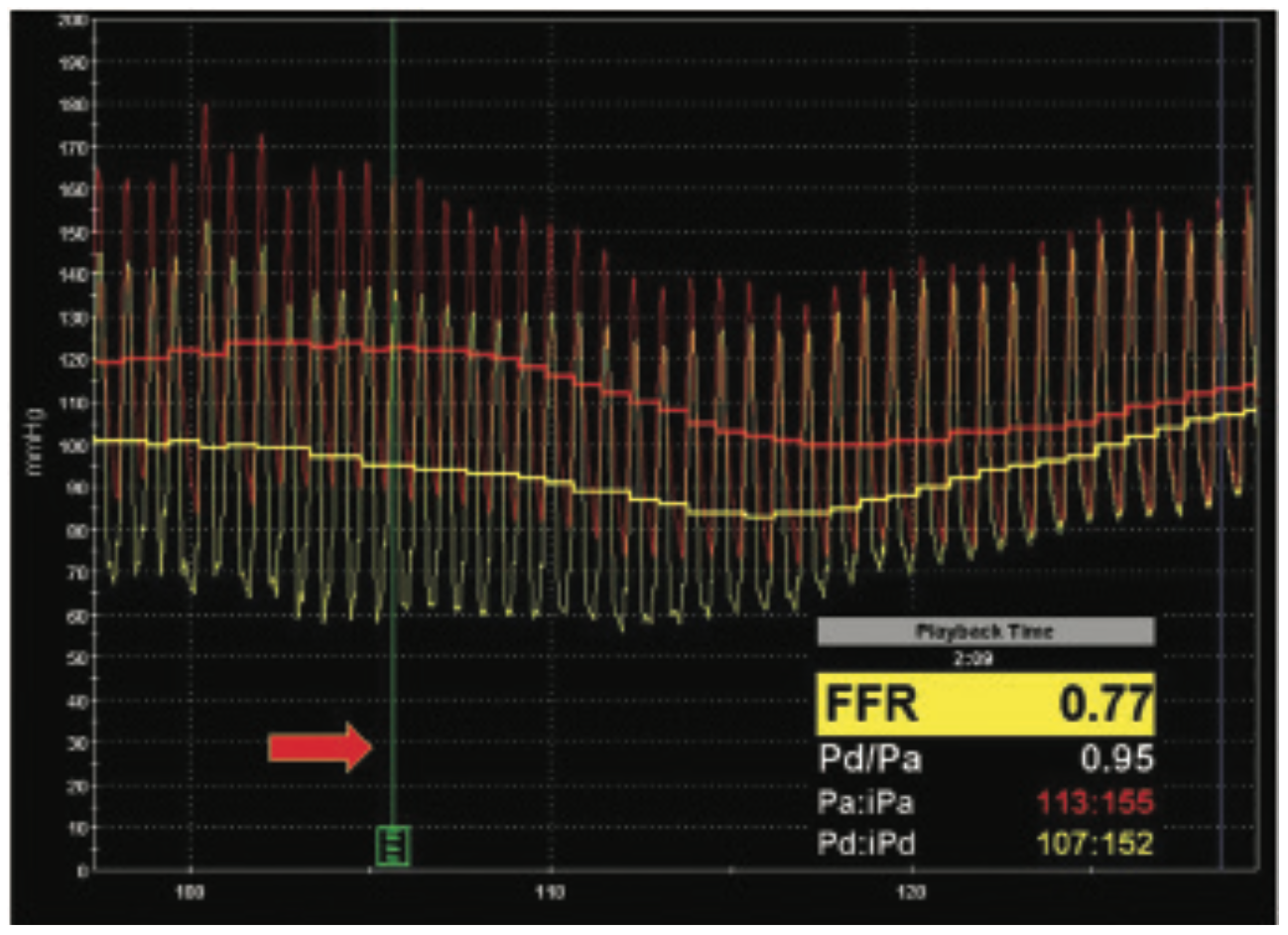 Kern Accurate FFR Figure 4A