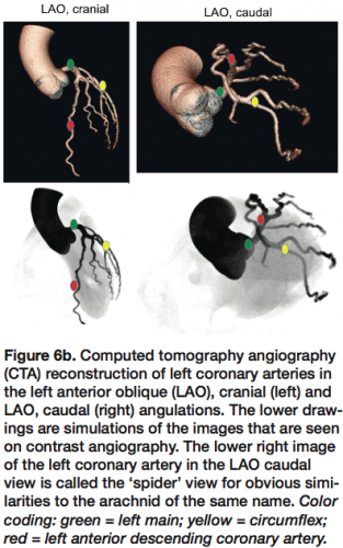 Kern Angiographic Projections_Figure 6b