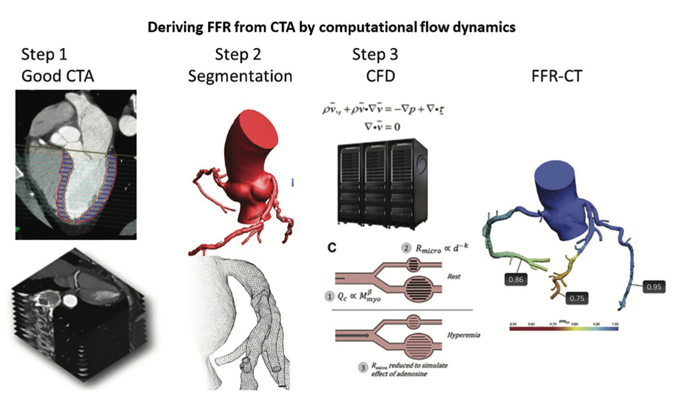 Kern Angiographic-Derived FFR Figure 1