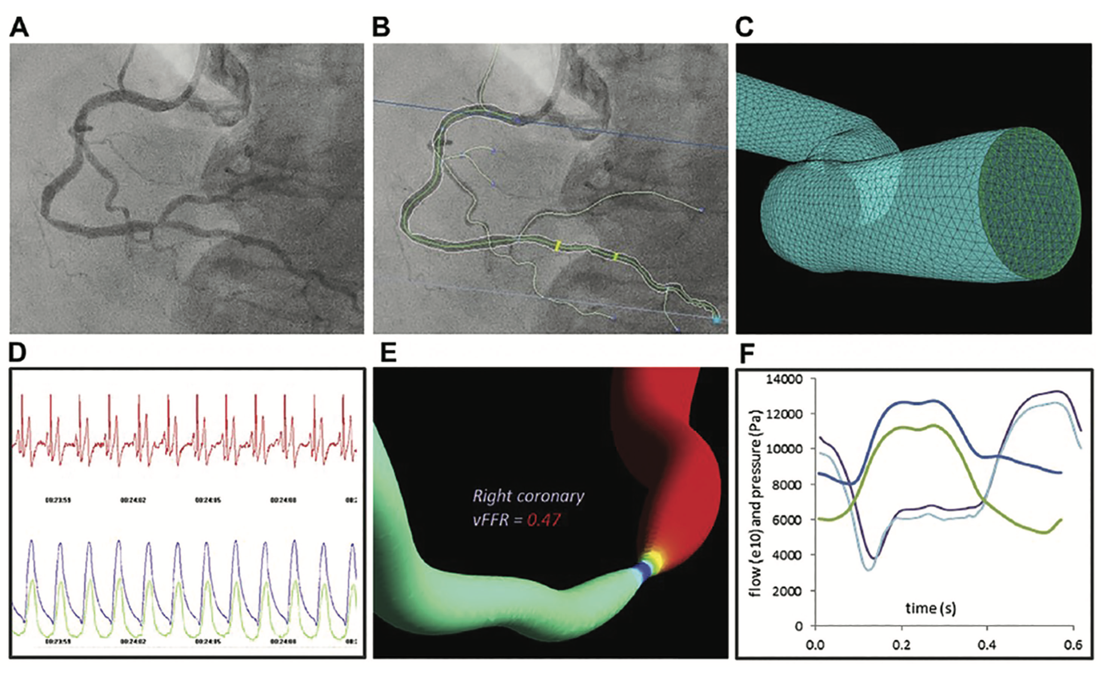 Kern Angiographic-Derived FFR Figure 2