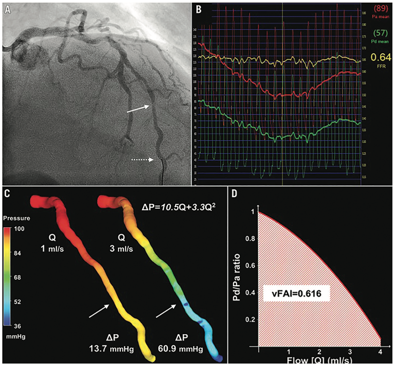 Kern Angiographic-Derived FFR Figure 3