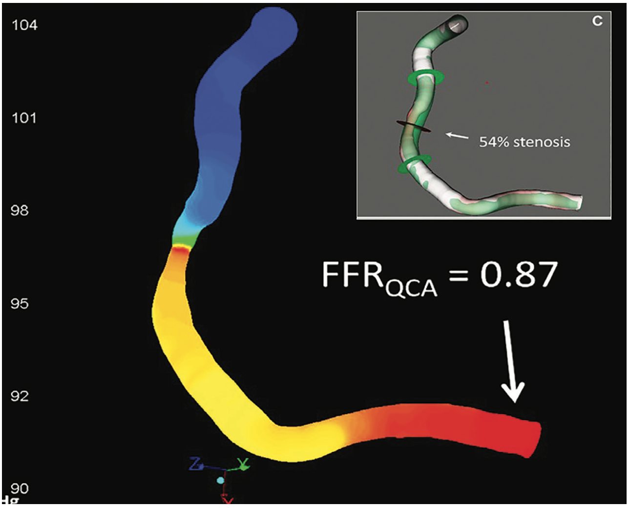 Kern Angiographic-Derived FFR Figure 4