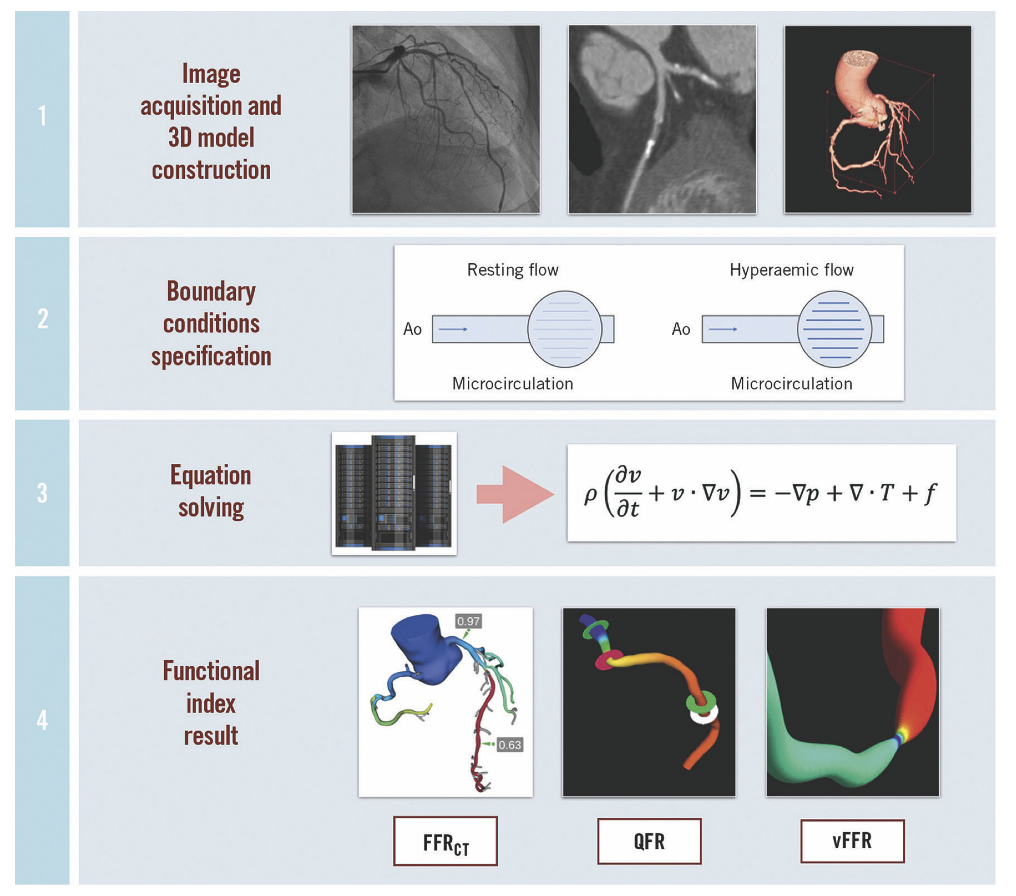 Figure 3. Steps needed to generate a functional angiographic image. Step 1: A standard coronary angiography is performed and subsequently analyzed, creating a three-dimensional anatomic model.&nbsp;Step 2: A physiologic model is selected. The mathematical formulas are applied whereby boundary conditions of pressure and flow are specified. Step 3: Once boundary conditions are specified, the patient-specific data (e.g., assumed resting coronary flow is proportional to subtended myocardial mass, and microvascular resistance is generally inversely correlated to vessel size and reduced during maximal hyperemia), the physical laws of fluid dynamics are applied, solving the Navier-Stokes equations, resistance equations, and/or some other simplified flow calculation. Step 4: Finally, the functional index of FFR, QFR, and/or vFFR is computed from the proprietary algorithms and displayed on the monitor.&nbsp;  Reprinted with permission from Faria D, Hennessey B, Shabbir A, et al. Functional coronary angiography for the assessment of the epicardial vessels and the microcirculation. EuroIntervention. 2023 Jun 19; 19(3): 203-221. doi:10.4244/EIJ-D-22-00969. &nbsp; &nbsp;