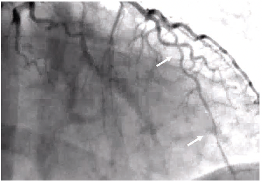 Figure 2. Patient #1. Later cine frame from 2024 angiogram. Arrows indicates SCAD in the LAD.