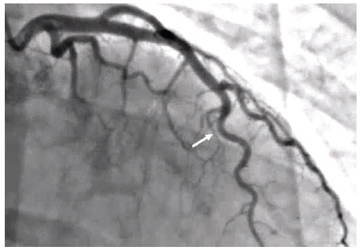 Figure 3. Patient #1 (Video #2). Cine frame from 2022 angiogram. Note caliber of LAD (arrow).