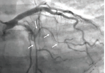 Patient #2. Cine angiogram frame showing diffusely dissected obtuse marginal 1 (arrows).