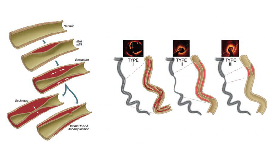 Kern CLD Mar Figure 5 Intramural hematoma SCAD