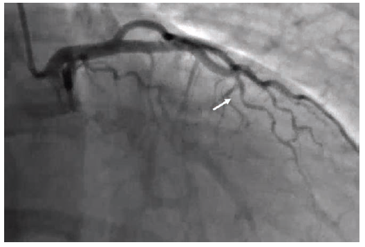 Figure 1. Patient #1 (Video #1). Cine frame from 2024 angiogram. Arrow indicates spontaneous coronary artery dissection (SCAD) in the left anterior descending (LAD) coronary artery.