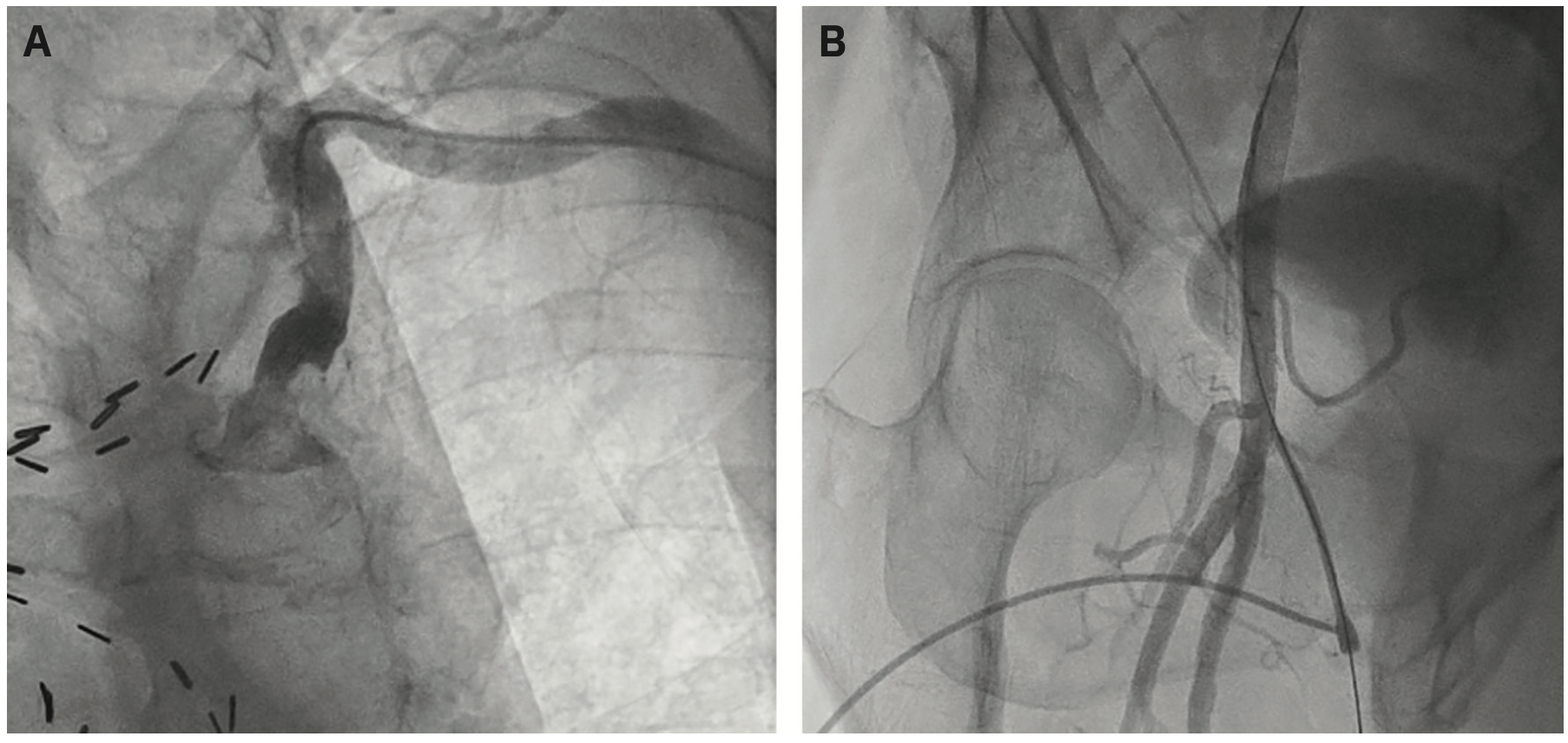 Kern Femoral Hemostasis Figure 1