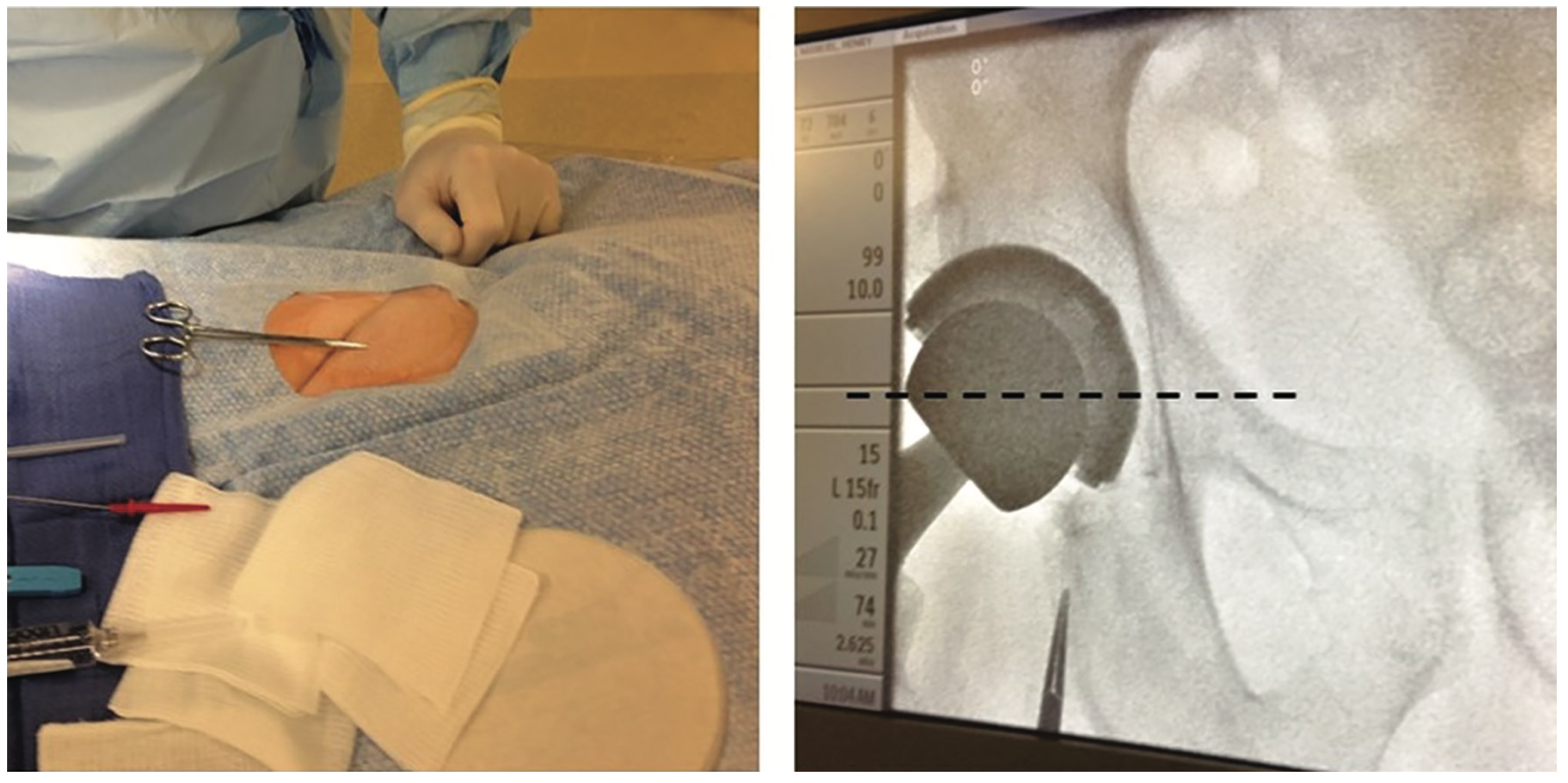 Kern Femoral Hemostasis Figure 3A