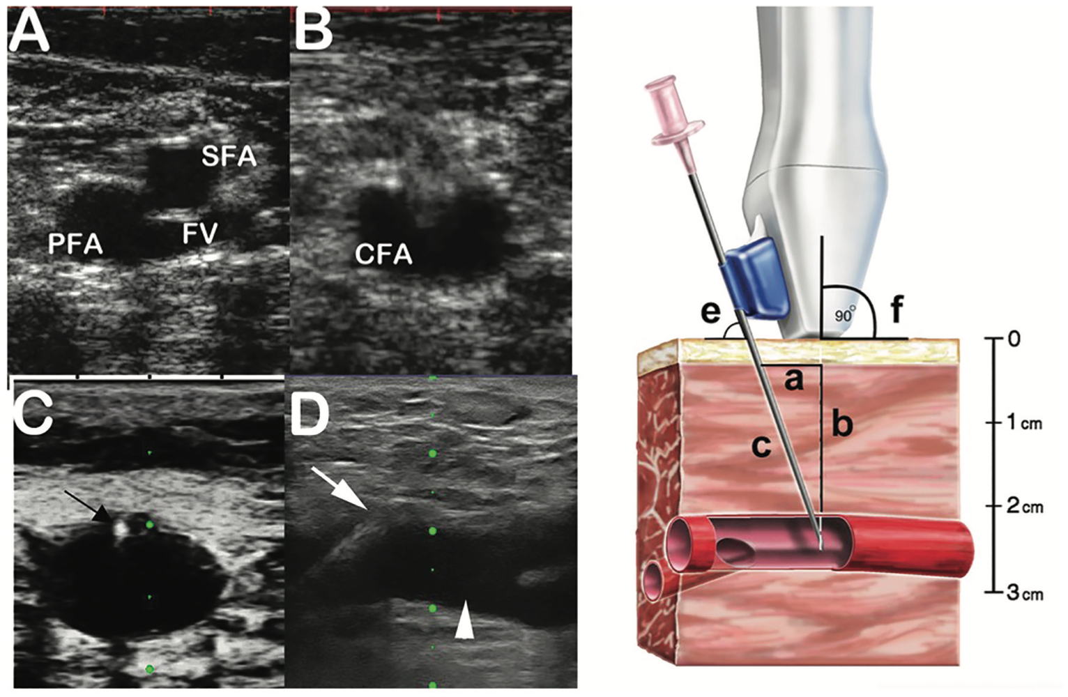 Kern Femoral Hemostasis Figure 4