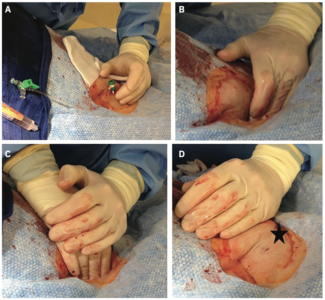Kern Femoral Hemostasis Figure 5