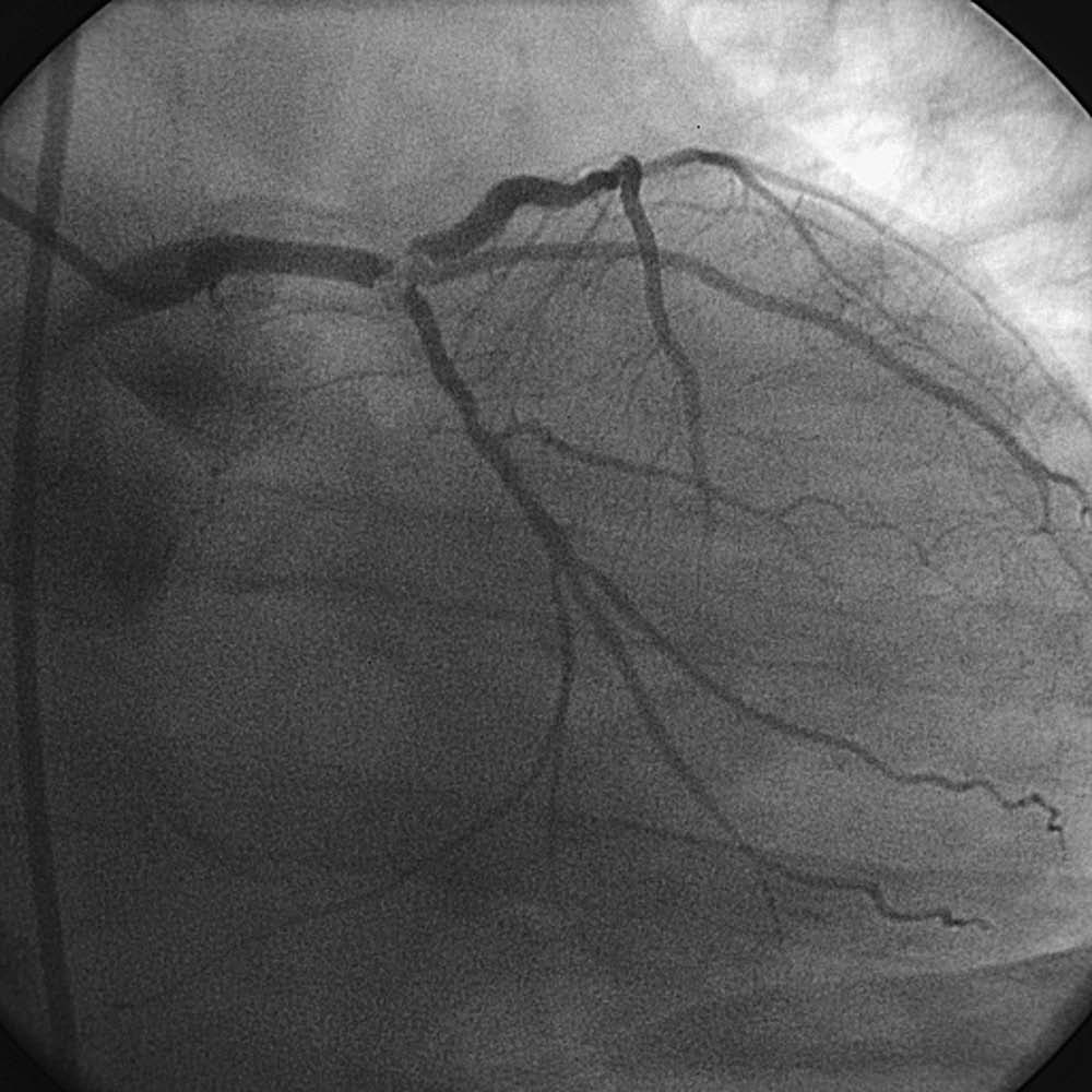 Figure. Cine angiogram frame in a 69-year-old man with angina at rest shows a severe distal left main trifurcation hazy narrowing involving the LAD and CFx (in 2001). The patient was sent to surgery, but likely could be a candidate for high-risk PCI today. The question of MCS in UPLM PCI remains open.
