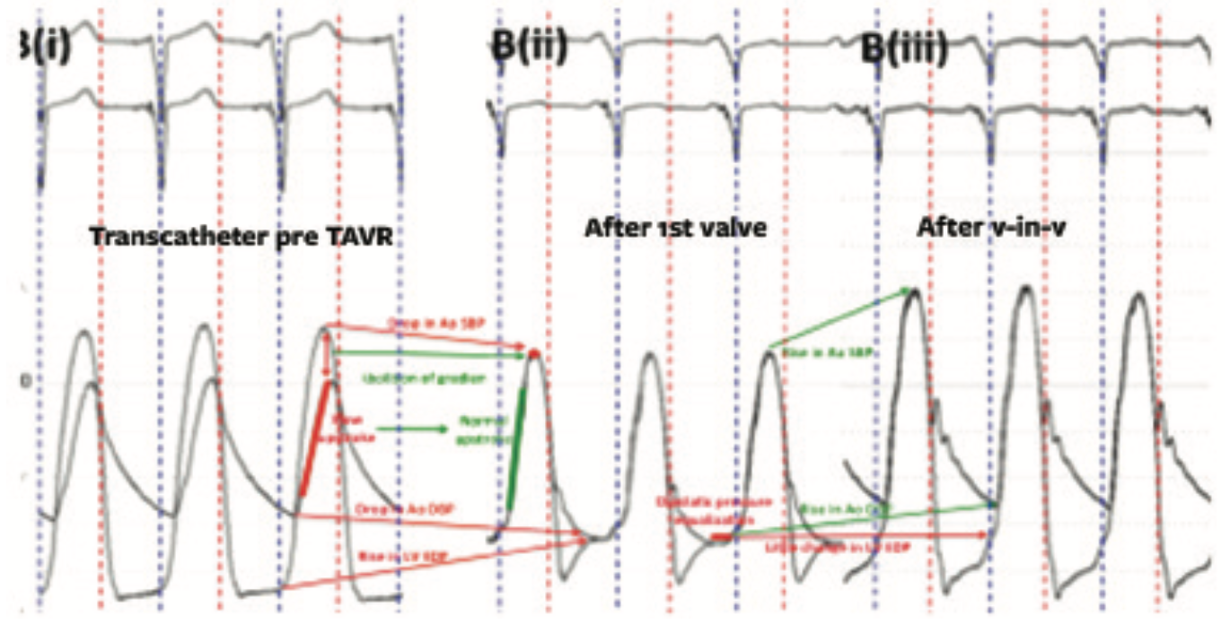 Kern Hemodynamics Figure 11