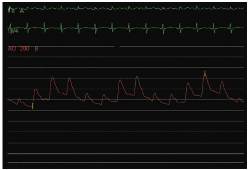 Kern Hemodynamics Figure 4