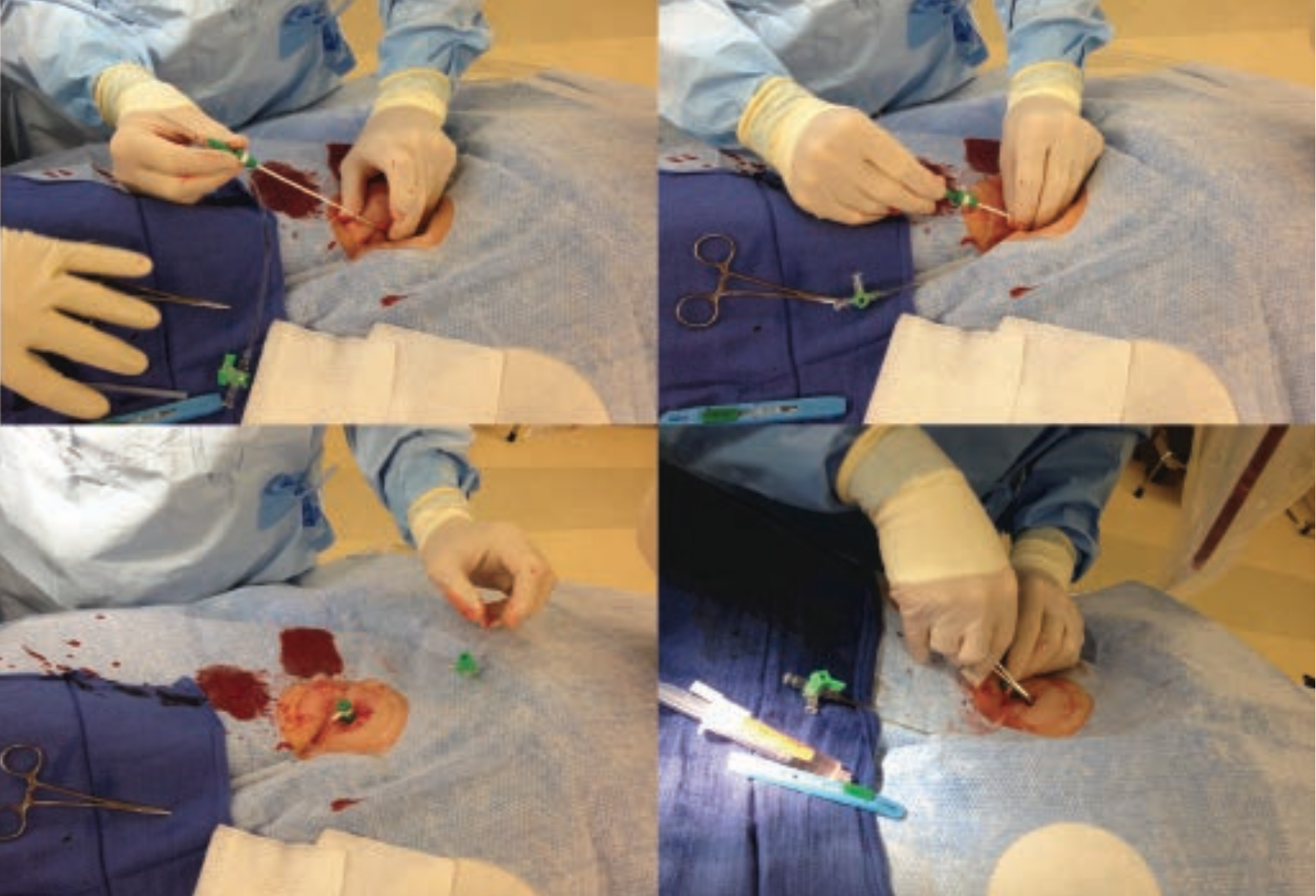 Kern Hemostasis Figure 5