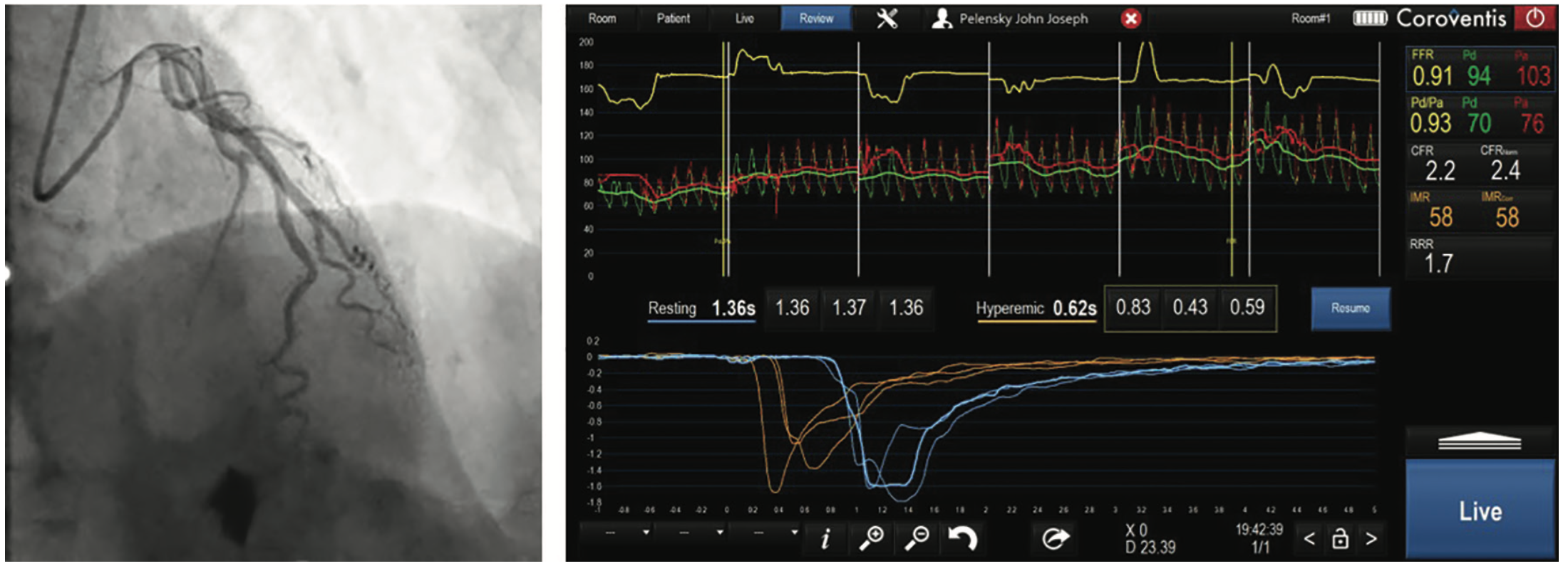 Kern INOCA Figure 4B