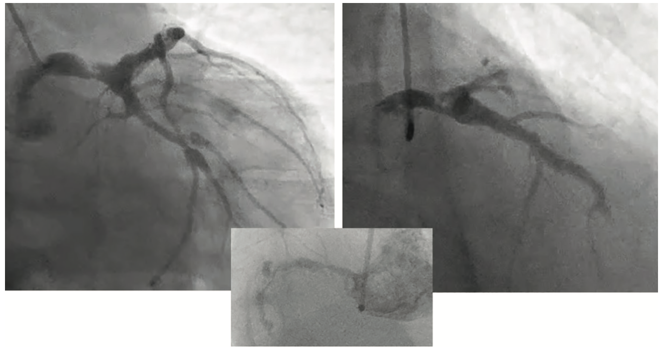 Kern Left Main PCI Figure 1