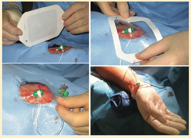 Kern Radial Sheath Figure 2