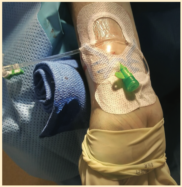 Kern Radial Sheath Figure 4B