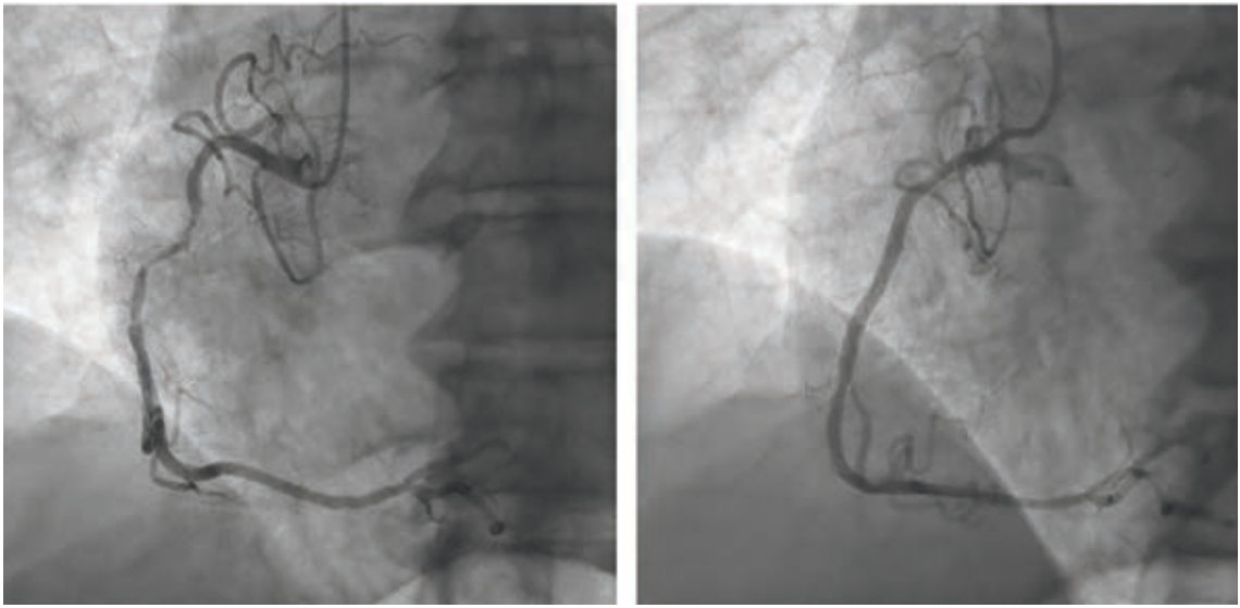Figure 3. Cineframes showing subacute occlusion of the right coronary artery before (left) and after (right) stenting.