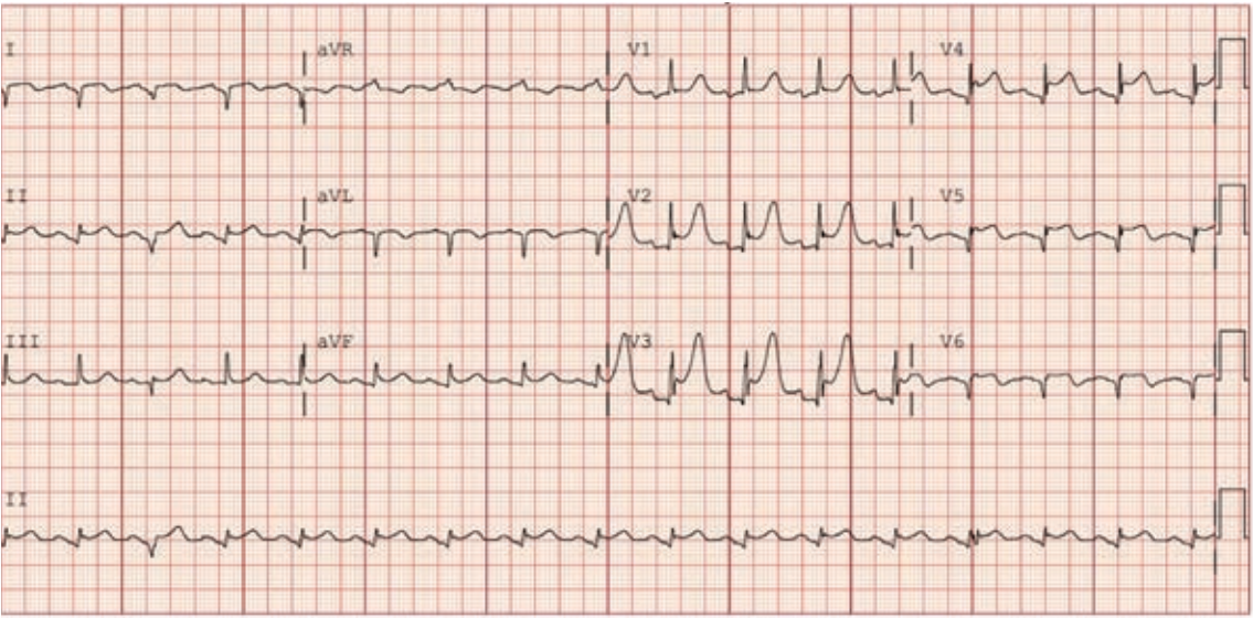 Figure 4. ECG after reperfusion with no-reflow and cardiogenic shock. &nbsp;Note the ST segment elevation now in the anterior leads with persistent extensive Q waves.