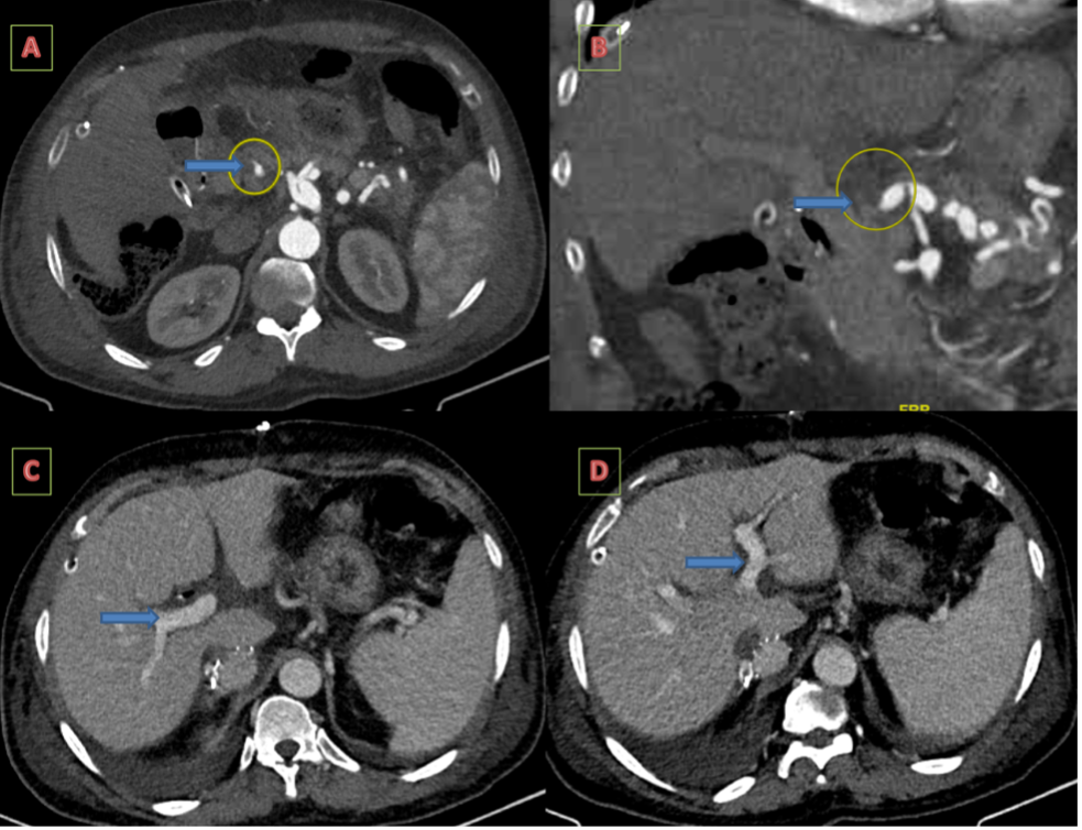 Figure 2. Occluded transplant hepatic artery on contrast-enhanced computed tomography. 