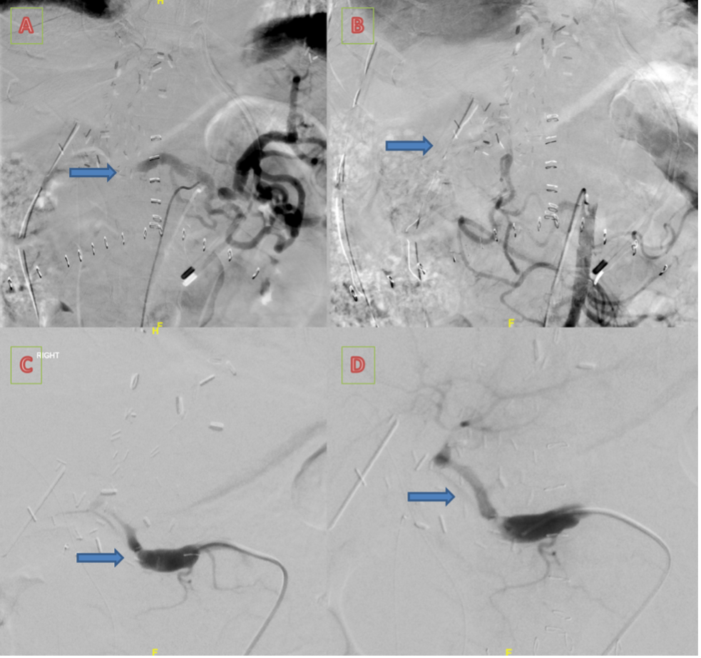Figure 3. Catheter angiogram from the celiac artery showing no flow within the transplant liver. 