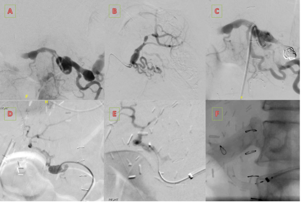 Figure 4. Post-intraarterial thrombolysis showing no flow with the transplant liver. 