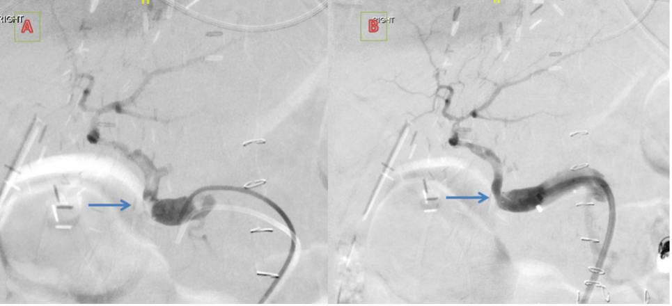 Figure 5. Comparison of flow with the transplant hepatic artery pre- and post-stenting at the anastomotic site.