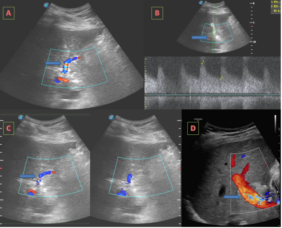 Figure 6. Post-flow diverter placement ultrasound showing good flow across the transplant hepatic artery and normal color filling in the portal veins.