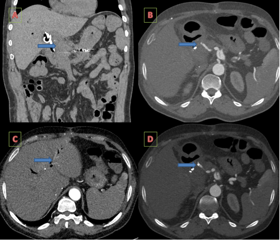 Figure 7. Follow-up contrast-enhanced computed tomography of the abdomen after 6 months showing contrast opacification within the transplant hepatic artery, intrahepatic part, and across the stent. 