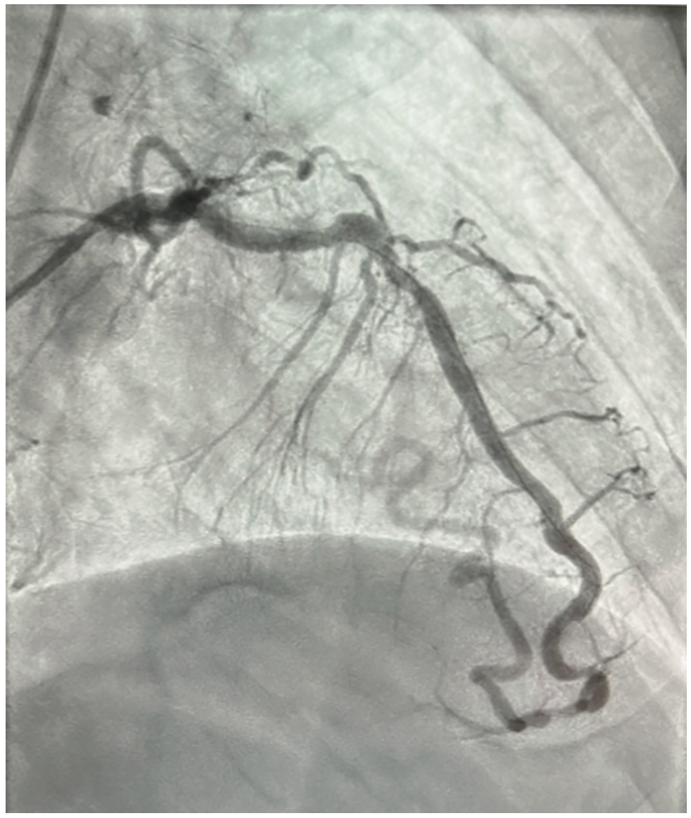 Khalafi Obtuse Marginal Artery Figure 1