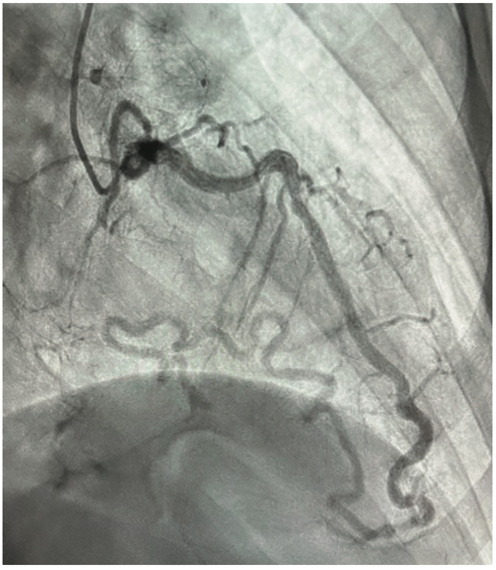 Khalafi Obtuse Marginal Artery Figure 2