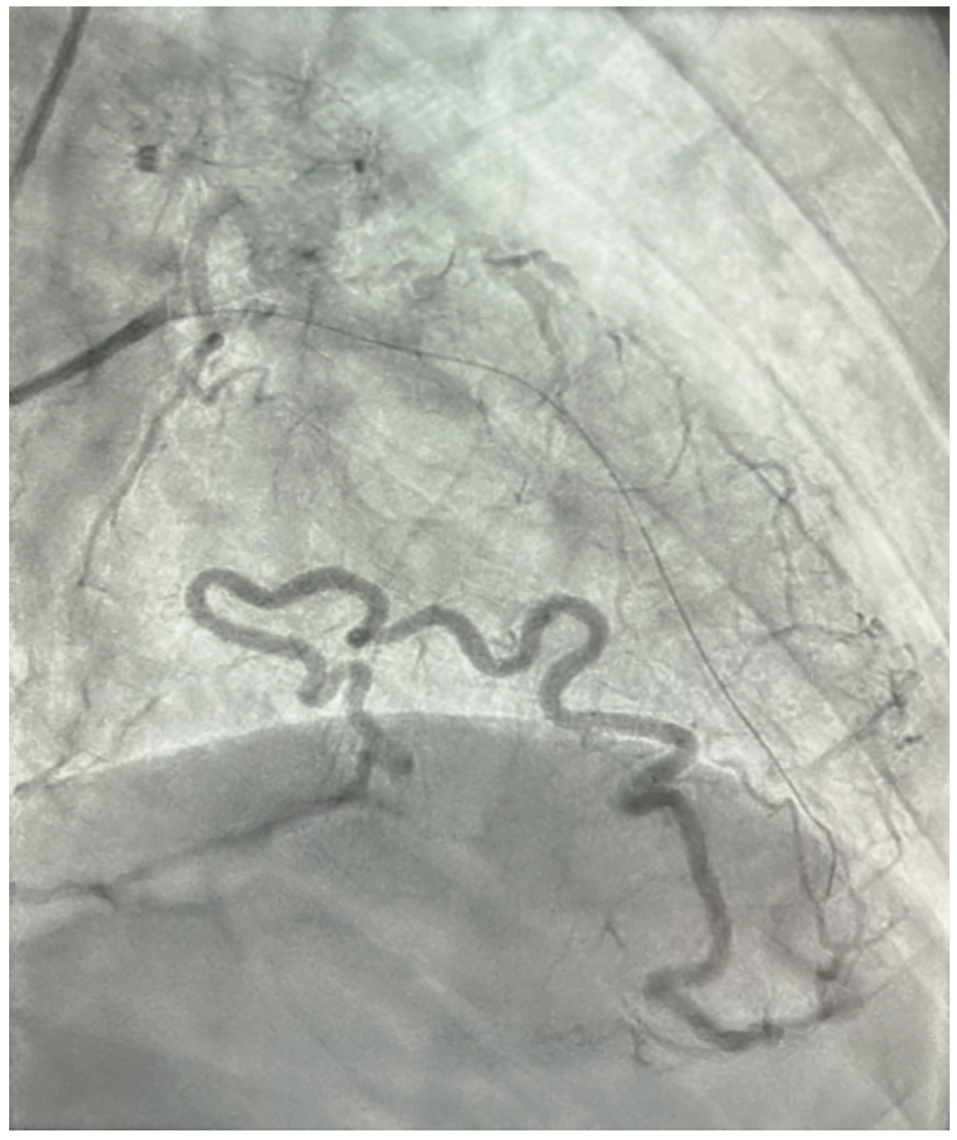 Khalafi Obtuse Marginal Artery Figure 3