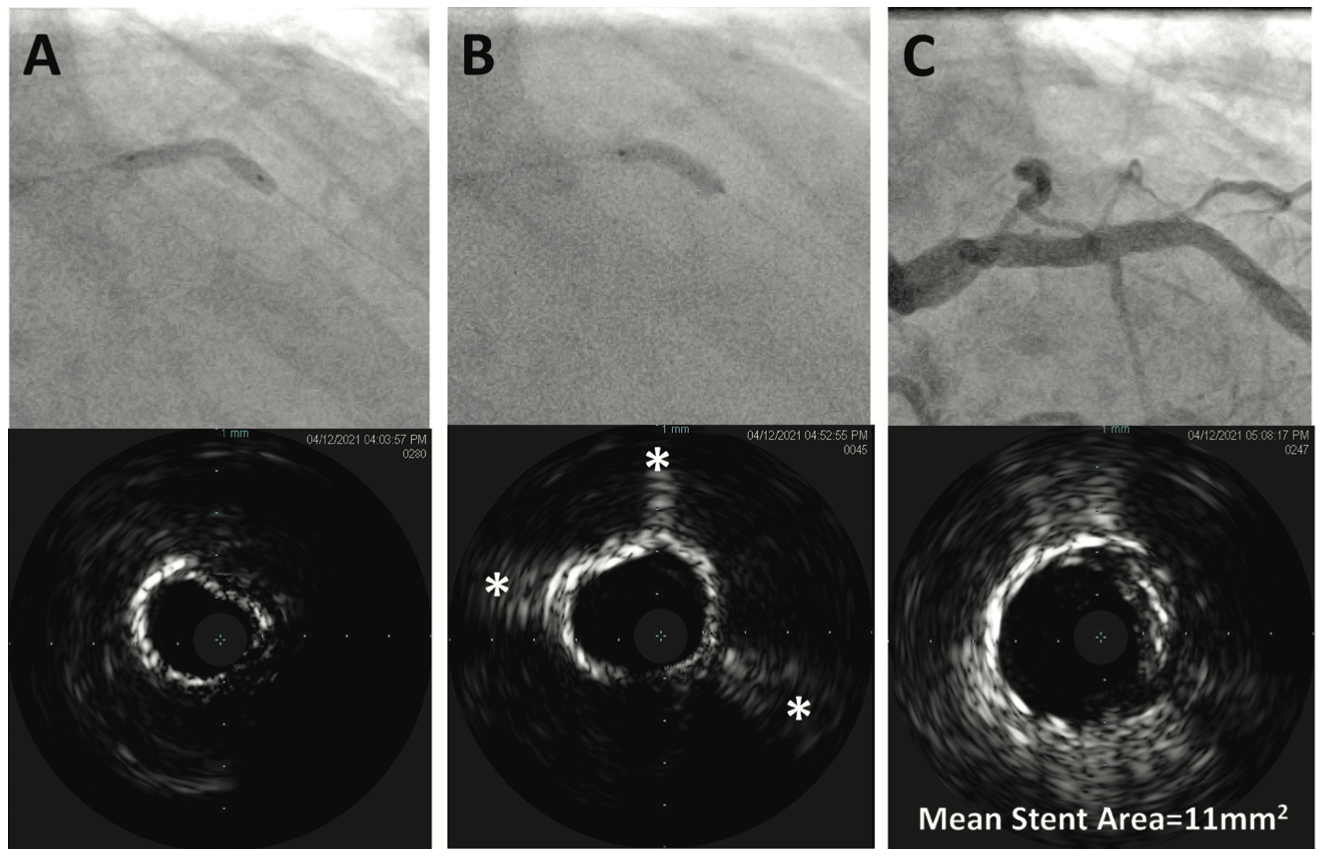 Khatri Calcified Vessels Figure 1