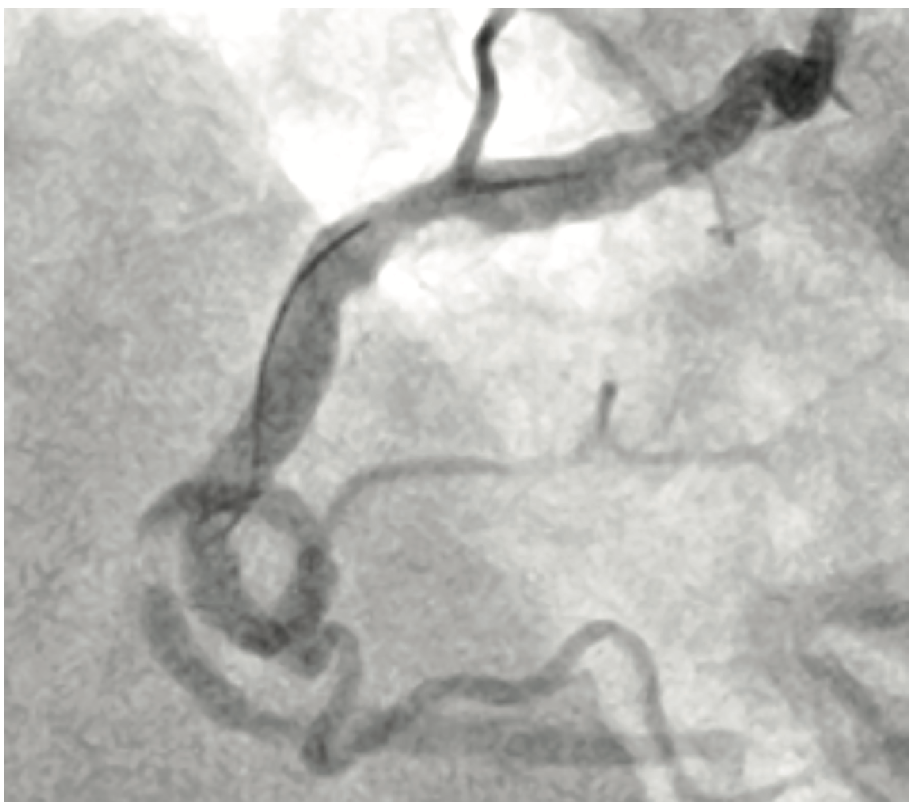 KhatriTerumo Complex PCI Figure 1