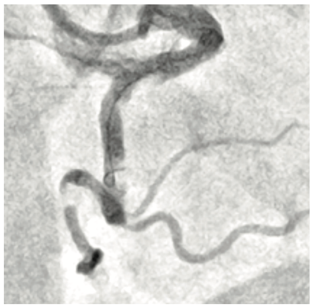 KhatriTerumo Complex PCI Figure 2