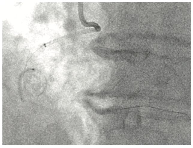 KhatriTerumo Complex PCI Figure 3