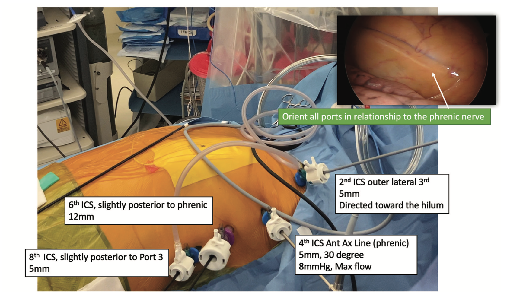 Kiankhooy Convergent “Plus” Figure 4