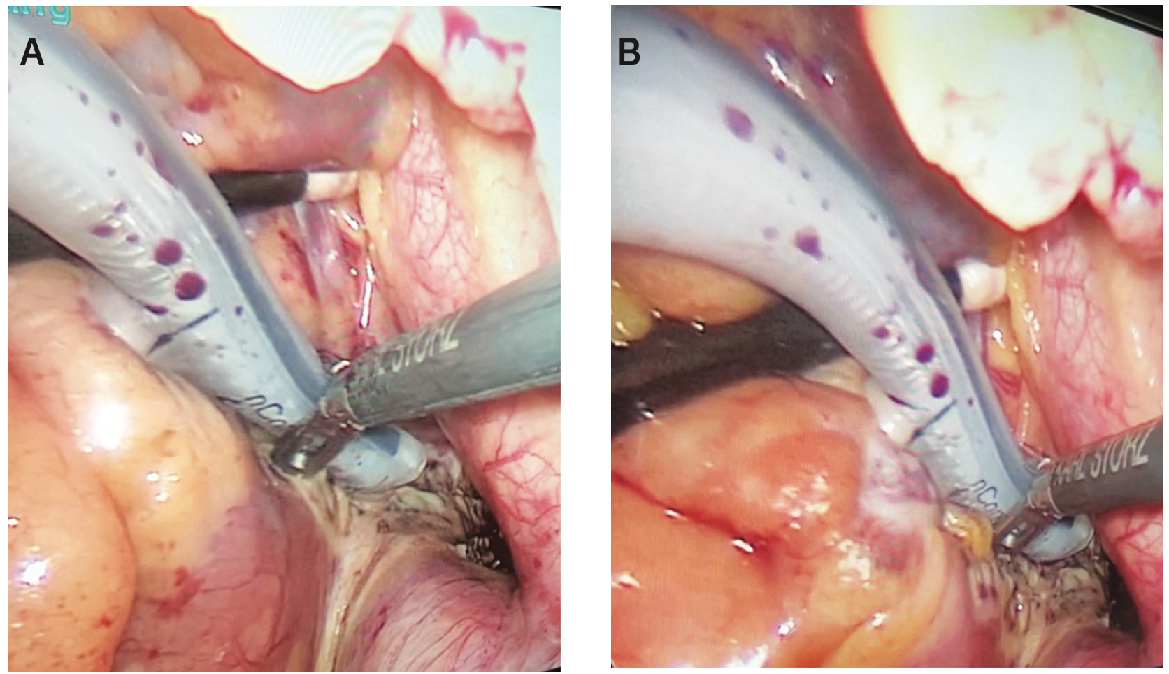 Kiankhooy Convergent “Plus” Figure 6
