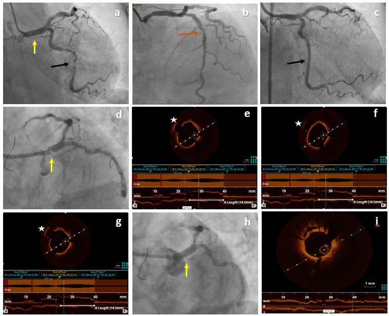 Figure. Angiography showing significant lesion