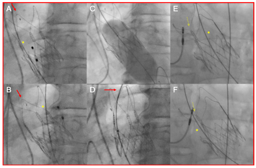 Kim Heart Valve Figure 3