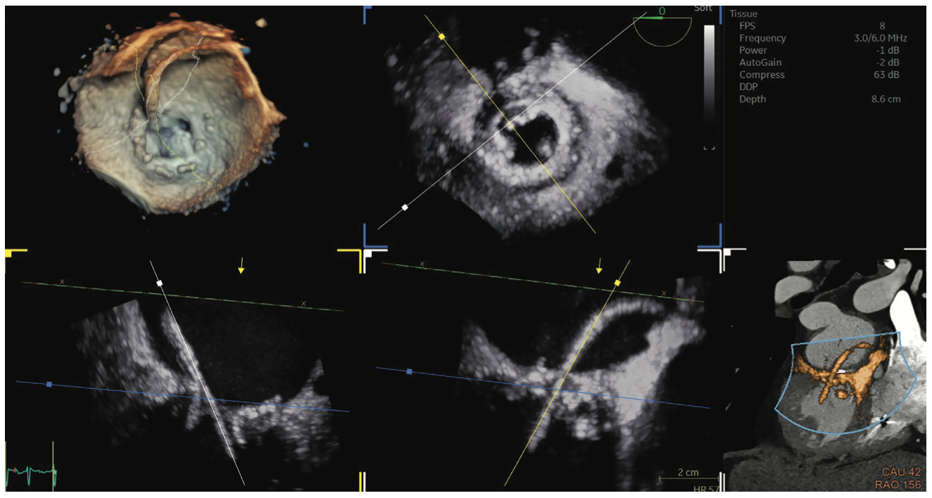 Kimmelstiel Structural Heart Interventions Figure 1