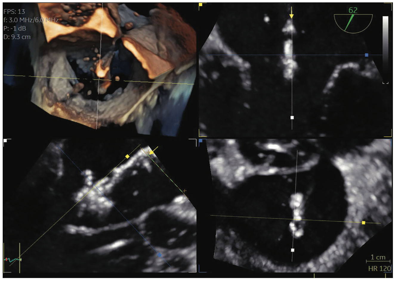 Kimmelstiel Structural Heart Interventions Figure 2