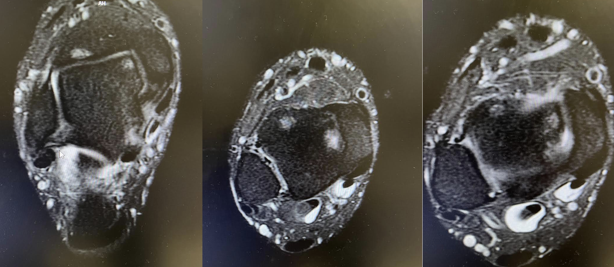 MRI of the right ankle at initial patient presentation.