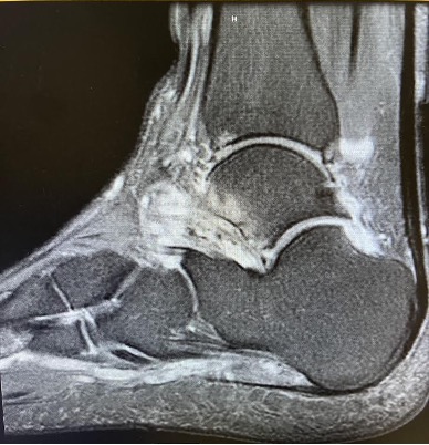 MRI of the right ankle at initial patient presentation.