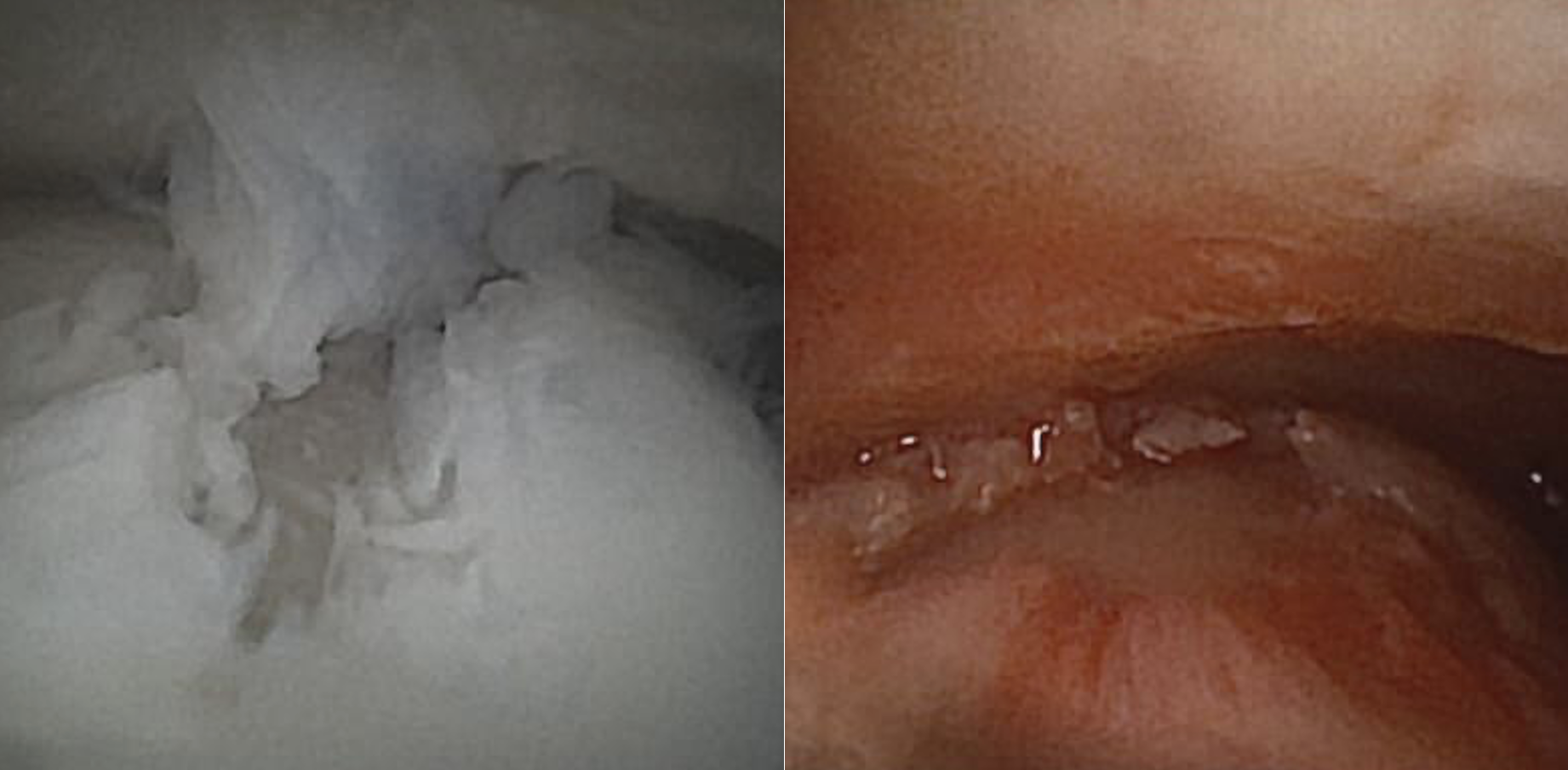 Intraoperative arthroscopic views of the medial talar lesion. (A) OLT depicted on the medial shoulder. (B) Intraoperative arthroscopic views of the medial talar lesion post debridement.