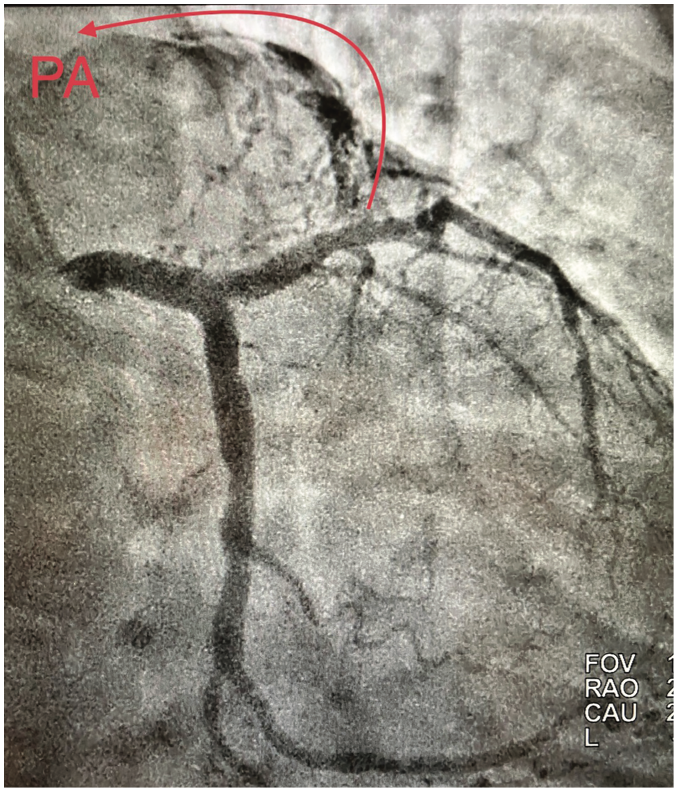 Klein Fistula Figure 1