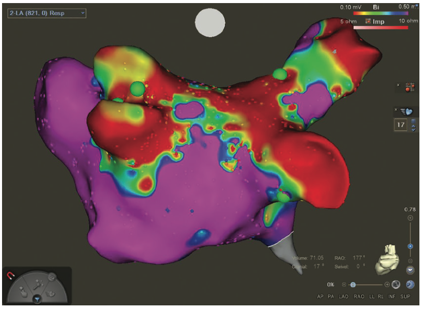 Knight Ablation Lesion Figure 1